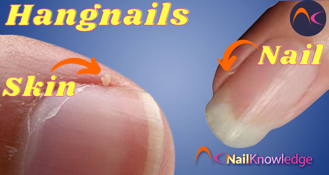 Hangnails