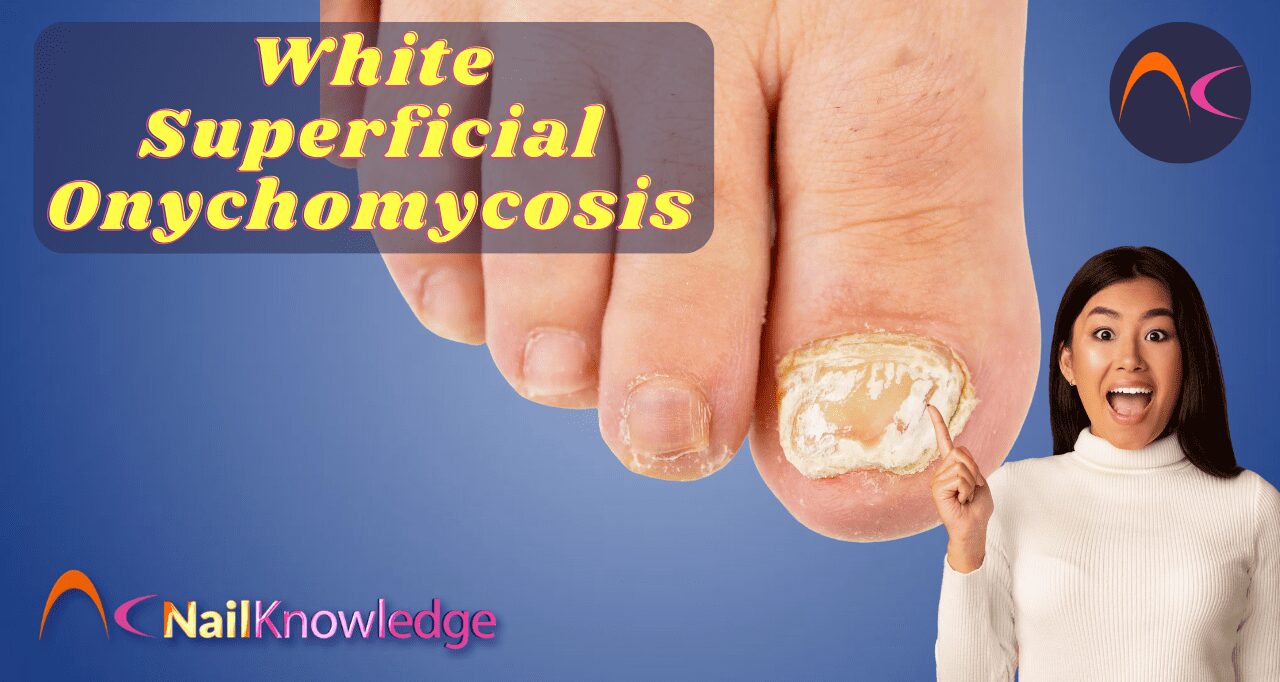 White Superficial Onychomycosis