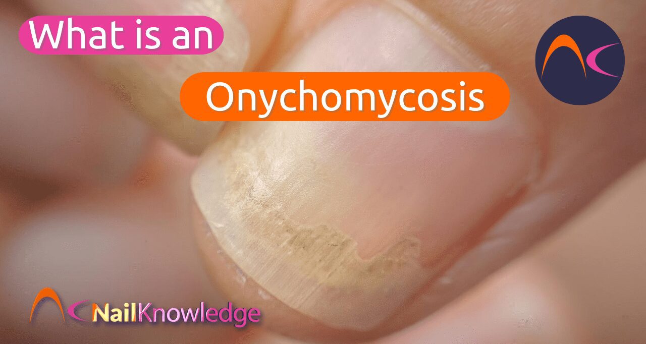 Onychomycosis