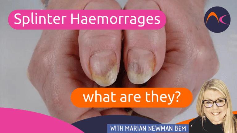 Nails Splinter Haemorrhage