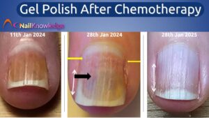 Gel Polish After Chemotherapy