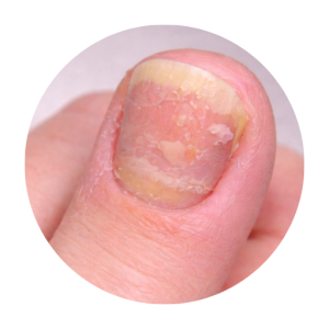 Nail and Skin Conditions